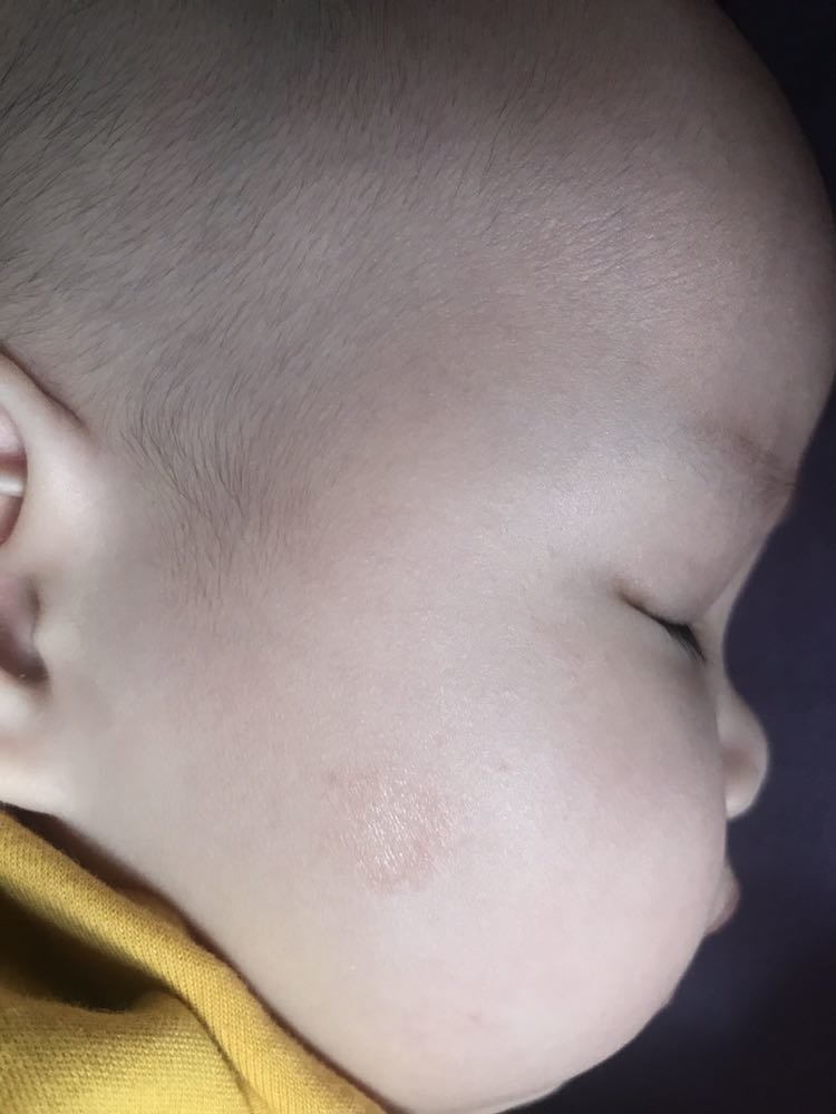 这是湿疹吗
