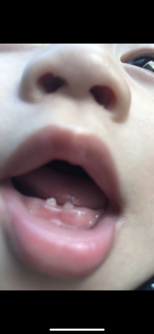 九个月乳牙就长了两颗还是歪的