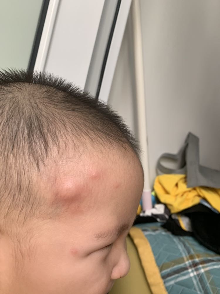 额头长了几个鼓鼓的包