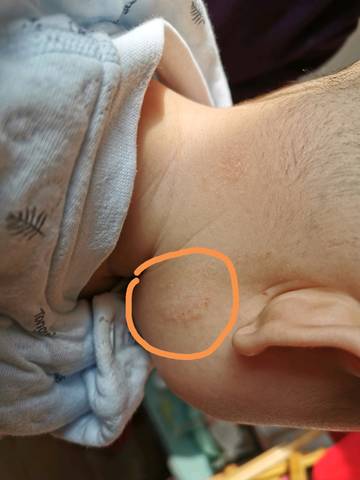 小孩5个月,耳后痒,总挠,这是怎么回事,怎么办?