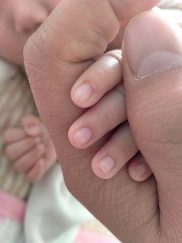 谁知道宝宝的手上小白泡是什么?
