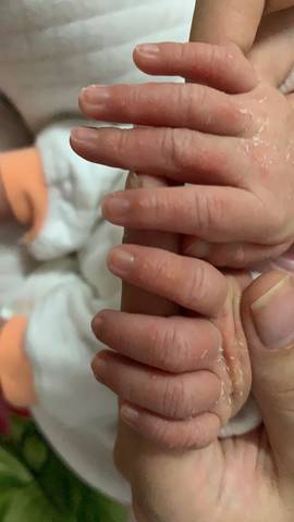 宝宝吃手手指起泡图片图片