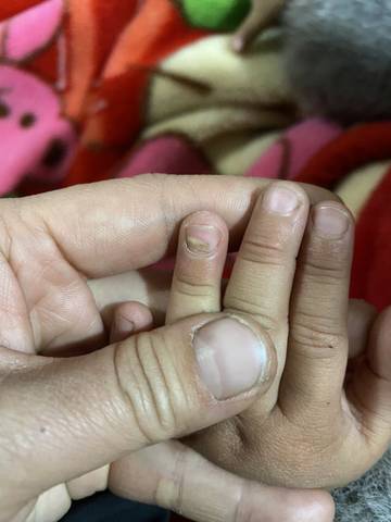 亲们,2岁9个月的宝宝指甲长了半边的灰指甲,是怎回事呢
