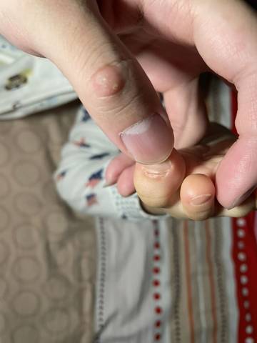 宝宝的脚指甲这里是怎么回事?感觉要分开了