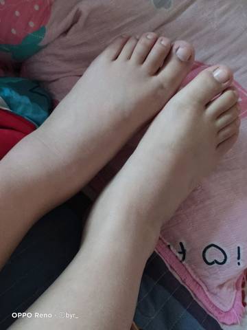 早上发现脚肿了一些.正常吗