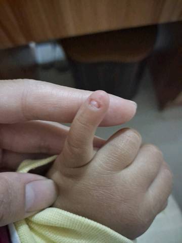 儿童手指甲根部脱层图片