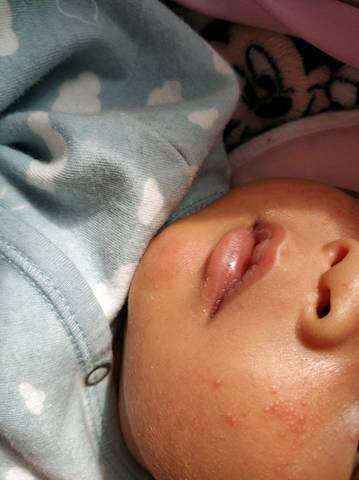 宝宝出生十三天了,这两天脸上出现了小红疹,是什么原因?