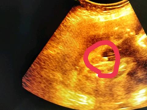 孕16周胎儿女孩彩超图图片