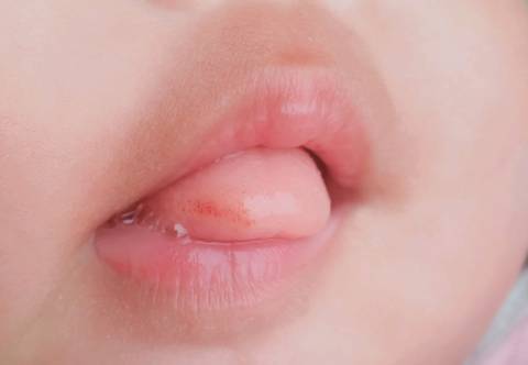 宝宝舌头草莓舌图片图片