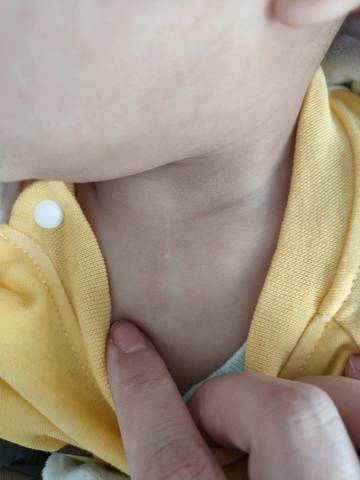 婴儿呼吸凹陷图片