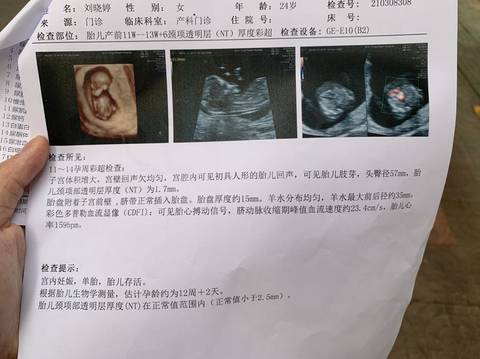 孕12周2天做的nt,平时爱吃酸,偶尔孕吐.
