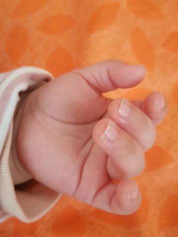 宝宝刚满六个月,这两天手指甲边上突然起皮是怎么回事?
