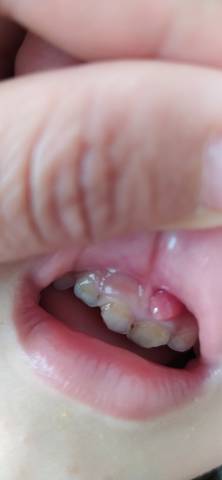 3岁宝宝牙龈肿起来一个大包,这是怎么了?
