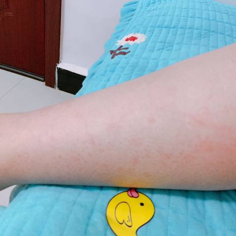 孕34周,突然发现腿上出现好多小红点,怎么回事