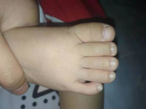 宝宝脚趾畸形图片