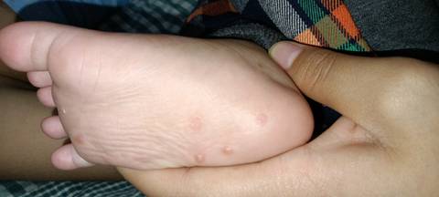 急急急,有宝妈知道宝宝手脚这样,怎么办的吗,帮忙看看