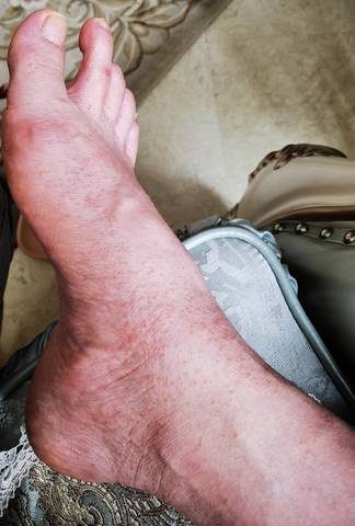 皮肤过敏还是湿疹?