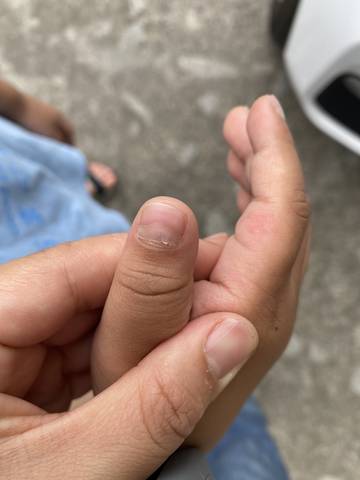 宝宝六岁半,最近宝宝指甲出现这种情况,有知道是什么原因吗?