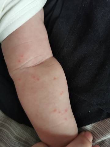 两个月大的宝宝一条胳膊上突然有很多小红疙瘩,也不知道是蚊子叮的