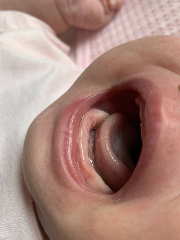 孩子舌头底下这样正常吗?