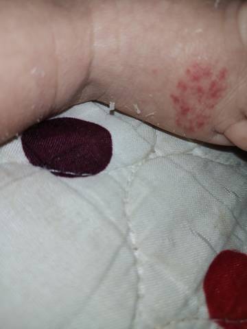 宝宝脚上有红斑图图片