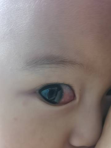 宝宝黄疸图片 眼角图片