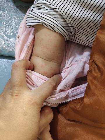 宝宝胳膊上起了一胳膊红点点,怎么回事?大家帮忙看一下
