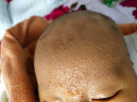 一个月宝宝脸上起疹子,涂什么好的快