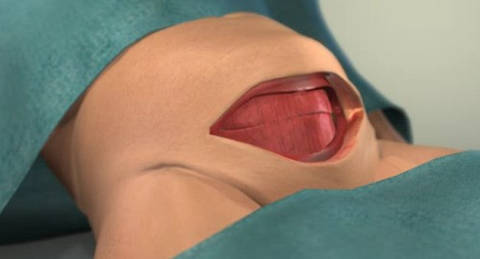 最直观图片:剖腹产手术全过程